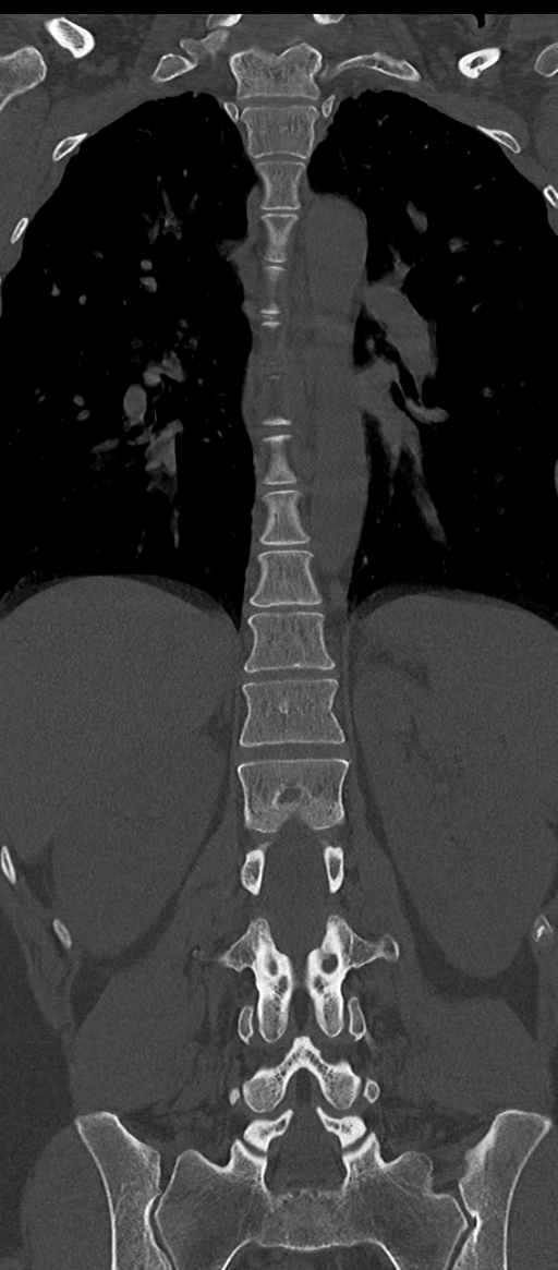 Normal thoracolumbar spine (Radiopaedia 43822-47309 Coronal bone window 50).png