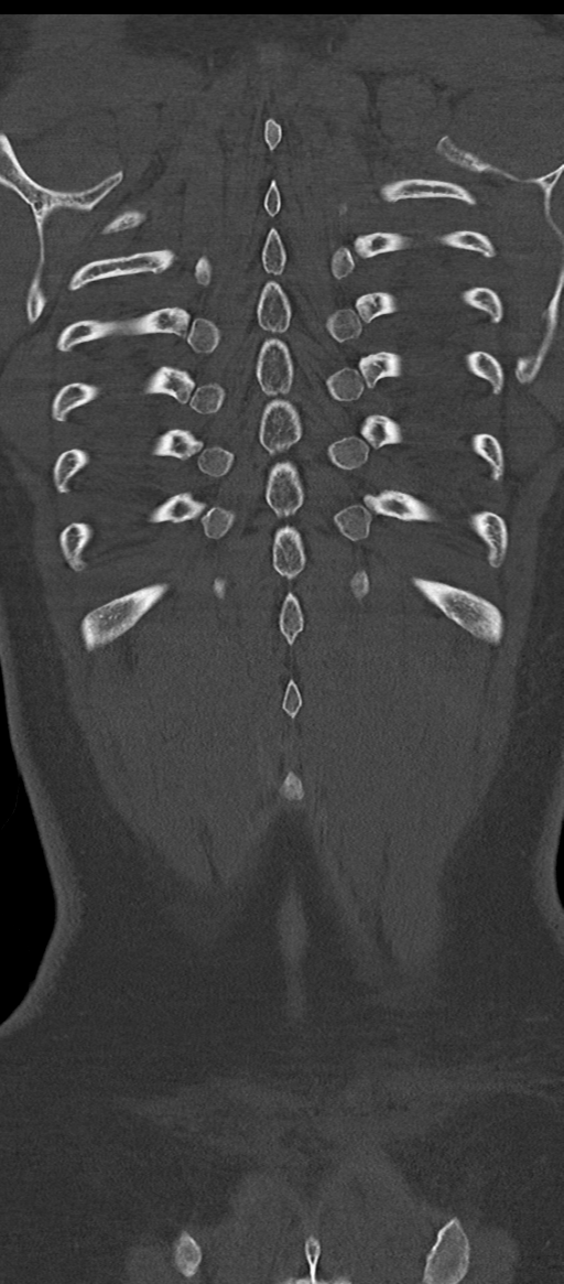 Normal thoracolumbar spine (Radiopaedia 43822-47309 Coronal bone window 81).png