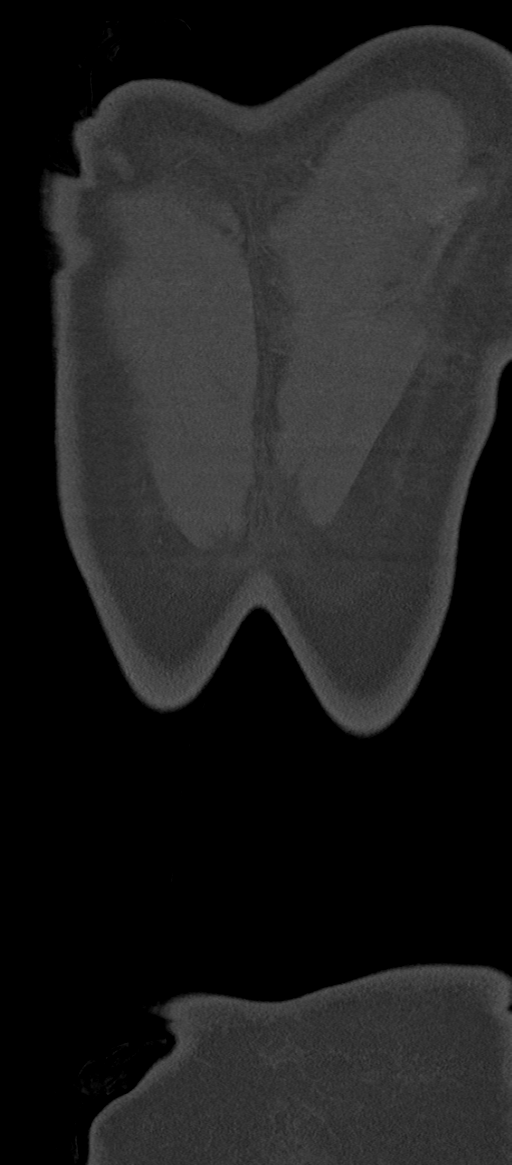 Normal thoracolumbar spine (Radiopaedia 43822-47309 Coronal bone window 95).png