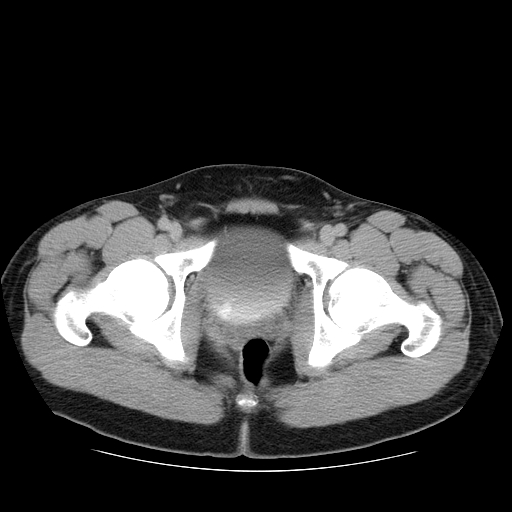Obstructing ureteric calculus (Radiopaedia 18615-18514 D 55).jpg