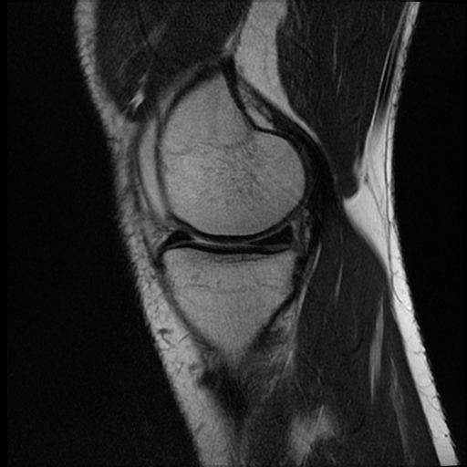 File:ACL acute full thickness tear - deep lateral femoral sulcus sign (Radiopaedia 38594-40740 Sagittal T2 5).jpg