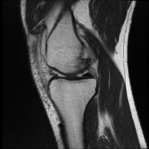 File:ACL acute full thickness tear - deep lateral femoral sulcus sign (Radiopaedia 38594-40740 Sagittal T2 7).jpg