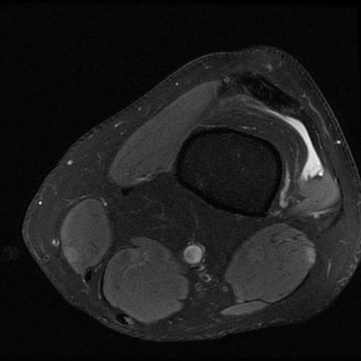 File:ACL and meniscal tears (Radiopaedia 79604-92797 Axial PD fat sat 2).jpg