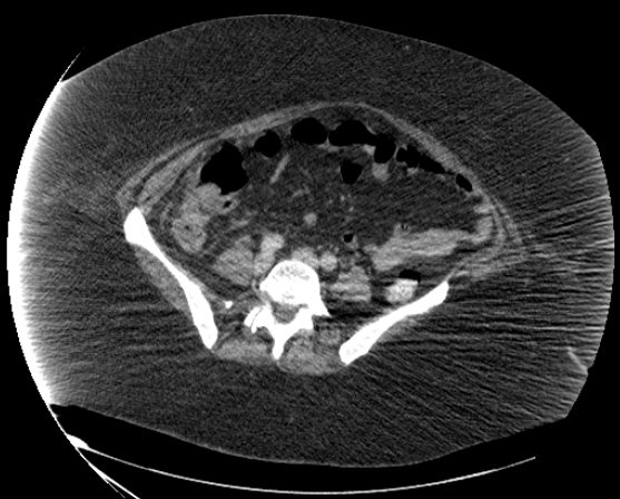 File:Abdominal abscess - pre and post percutaneous drainage (Radiopaedia 60209-67816 Axial 58).png
