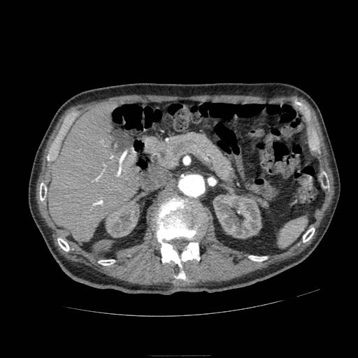 Abdominal aortic aneurysm (Radiopaedia 13341-13340 Axial C+ arterial phase 60).jpg
