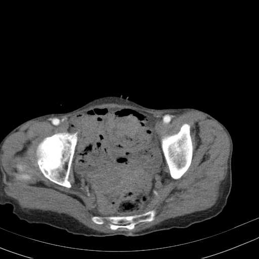 File:Abdominal aortic aneurysm (Radiopaedia 20827-20742 Axial C+ arterial phase 35).jpg