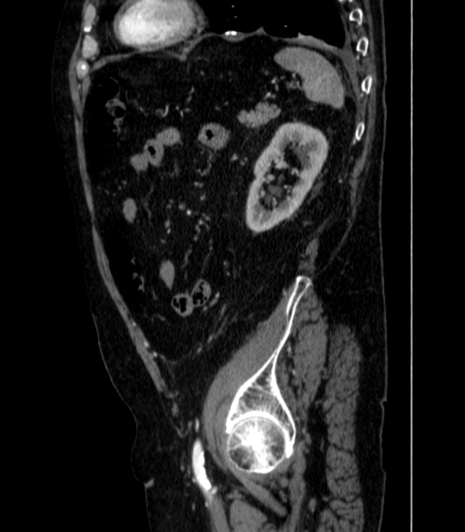 Abdominal aortic aneurysm (Radiopaedia 25855-26001 Sagittal C+ arterial phase 62).jpg
