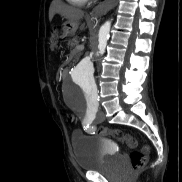 Abdominal aortic aneurysm (Radiopaedia 29248-29660 Sagittal C+ arterial phase 27).jpg
