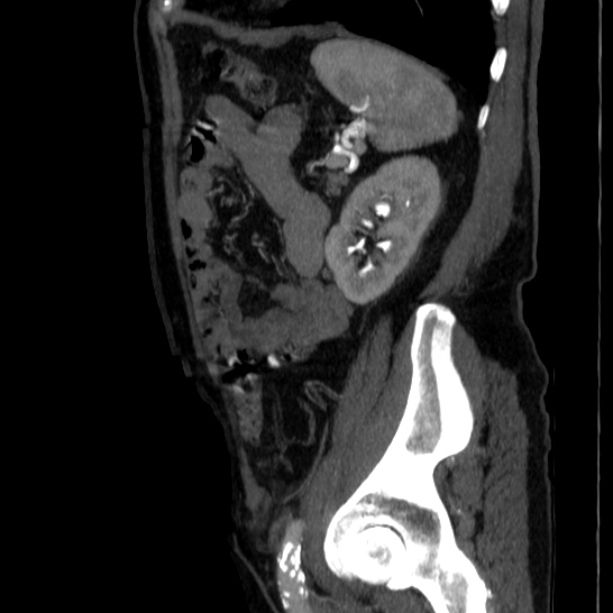 Abdominal aortic aneurysm (Radiopaedia 29248-29660 Sagittal C+ arterial phase 42).jpg