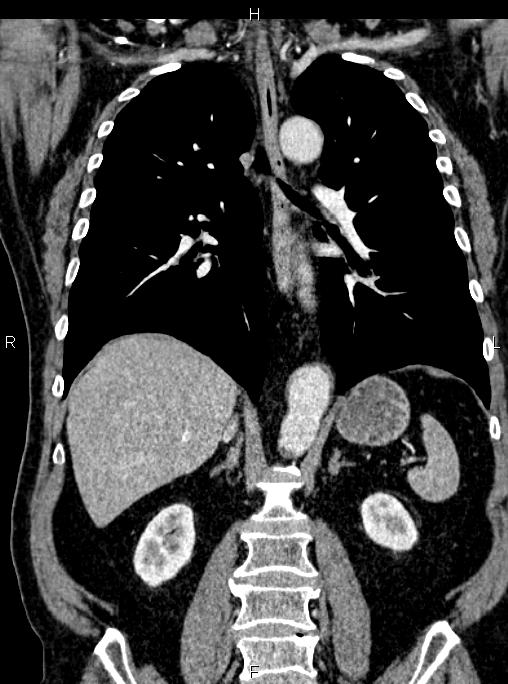 Abdominal aortic aneurysm (Radiopaedia 83094-97462 Coronal renal cortical phase 58).jpg