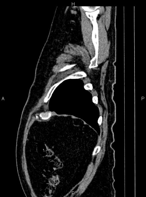 Abdominal aortic aneurysm (Radiopaedia 83094-97462 Sagittal renal cortical phase 112).jpg