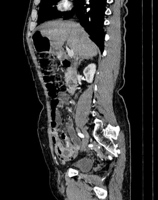 Abdominal aortic aneurysm (Radiopaedia 83581-98689 Sagittal C+ arterial phase 16).jpg