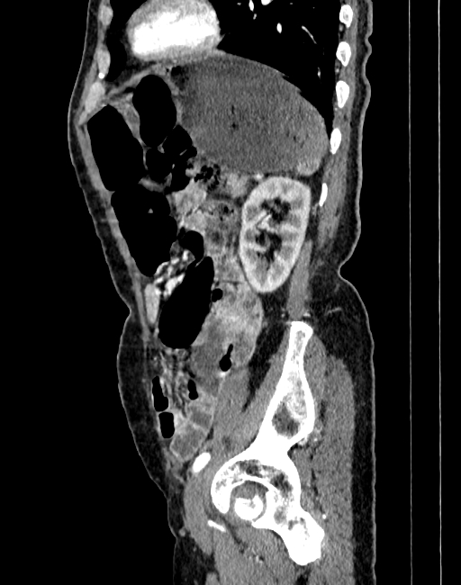 Abdominal aortic aneurysm (Radiopaedia 83581-98689 Sagittal C+ arterial phase 92).jpg