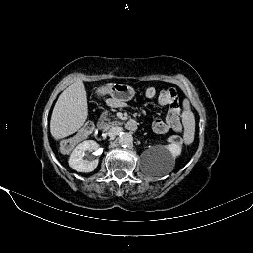 Abdominal aortic aneurysm (Radiopaedia 85063-100606 Axial C+ delayed 38).jpg