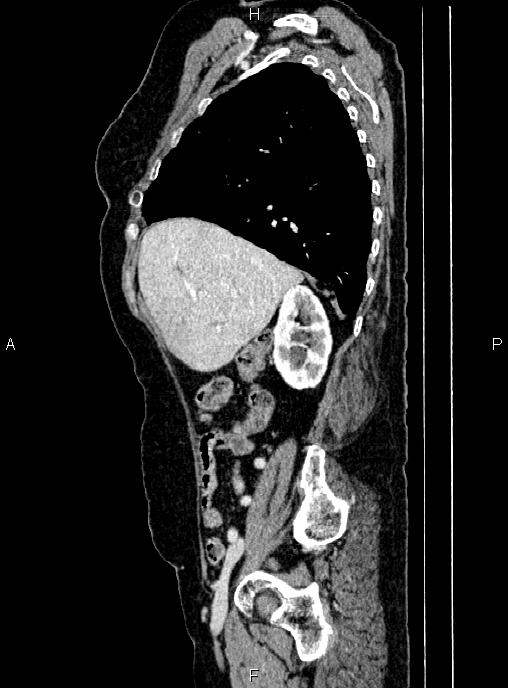 Abdominal aortic aneurysm (Radiopaedia 85063-100606 Sagittal C+ arterial phase 21).jpg