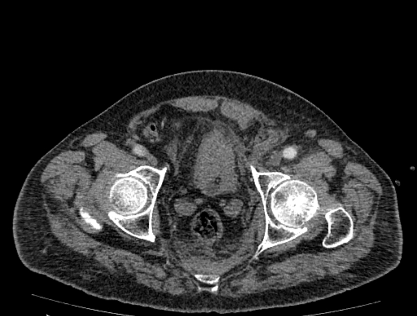 Abdominal aortic aneurysm rupture (Radiopaedia 54179-60362 Axial C+ arterial phase 52).jpg