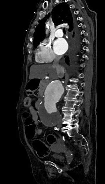 Abdominal aortic aneurysm with thrombus fissuration (Radiopaedia 73192-83919 Sagittal C+ arterial phase 79).jpg