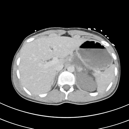 File:Abdominal multi-trauma - devascularised kidney and liver, spleen and pancreatic lacerations (Radiopaedia 34984-36486 Axial C+ delayed 17).png