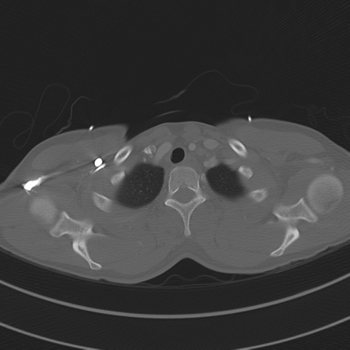 File:Abdominal multi-trauma - devascularised kidney and liver, spleen and pancreatic lacerations (Radiopaedia 34984-36486 I 13).png