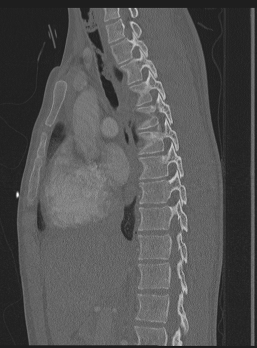 Abdominal multi-trauma - devascularised kidney and liver, spleen and pancreatic lacerations (Radiopaedia 34984-36486 Sagittal bone window 40).png
