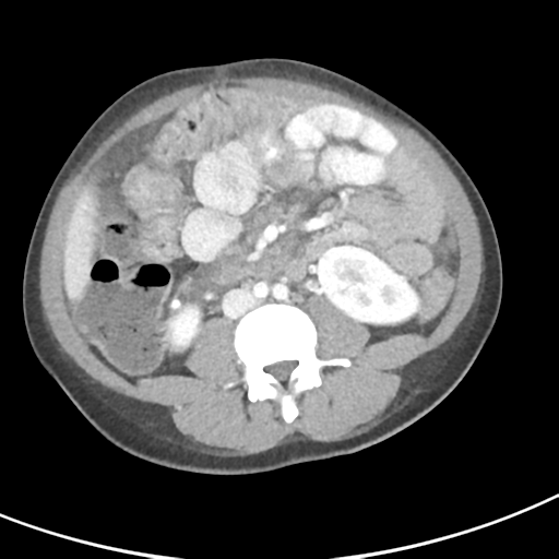 File:Abdominal tuberculosis and appendicitis (Radiopaedia 65631-74735 Axial C+ portal venous phase 39).png