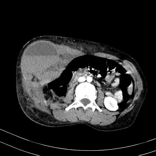 File:Abdominal wall hematoma with active bleeding (Radiopaedia 83915-99117 Axial renal cortical phase 43).jpg