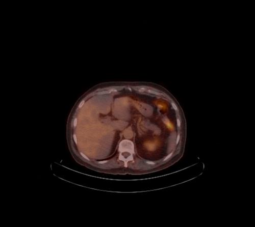 Abdominal wall metastasis from colorectal carcinoma (Radiopaedia 31016-31719 C 84).jpg