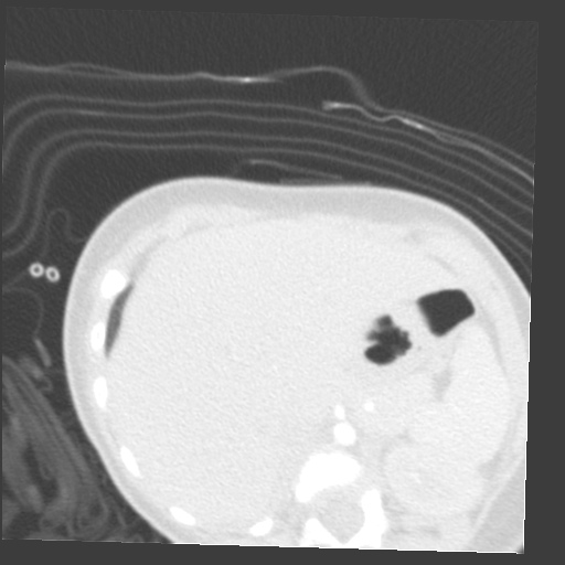 File:Aberrant left pulmonary artery (pulmonary sling) (Radiopaedia 42323-45435 Axial lung window 43).jpg