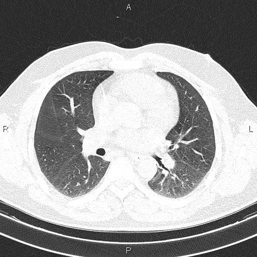 File:Aberrant right subclavian artery (Radiopaedia 87093-103354 Axial lung window 55).jpg