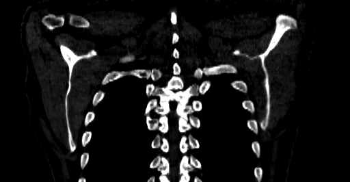 Accesory rib joint (Radiopaedia 71987-82452 Coronal bone window 66).jpg