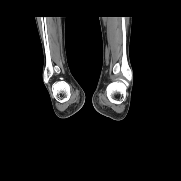 Accessory soleus muscle (Radiopaedia 61069-68943 Coronal non-contrast 55).jpg