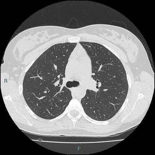 Accidental foreign body aspiration (seamstress needle) (Radiopaedia 77740-89983 Axial lung window 24).jpg