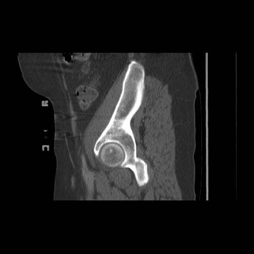 File:Acetabular fracture (Radiopaedia 13193-13212 Sagittal bone window 24).jpg
