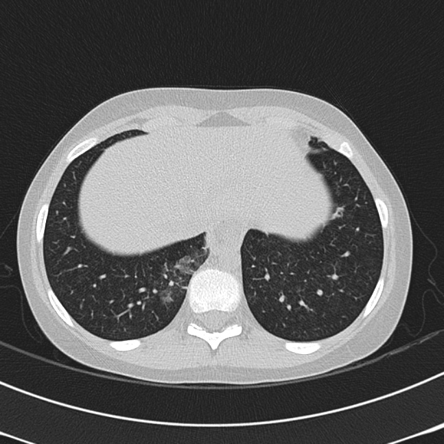 Achalasia (Radiopaedia 14946-14878 Axial lung window 66).jpg