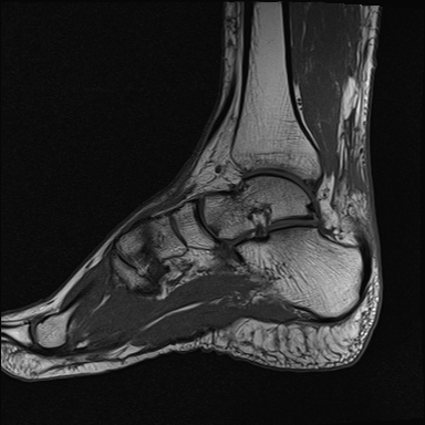 File:Achilles tendon tear (Radiopaedia 77615-89819 Sagittal T1 11).jpg