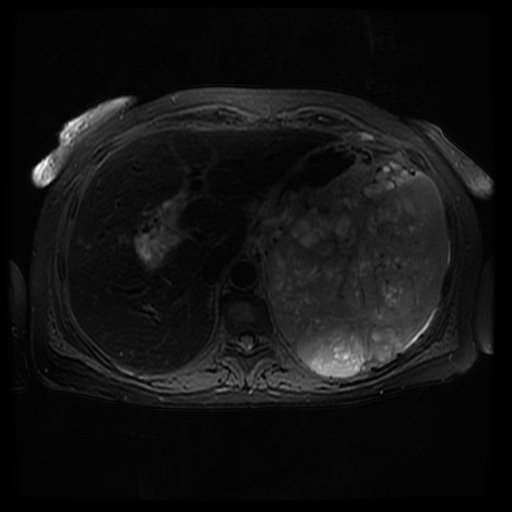 Acinar cell carcinoma of the pancreas (Radiopaedia 75442-86668 Axial T2 fat sat 21).jpg