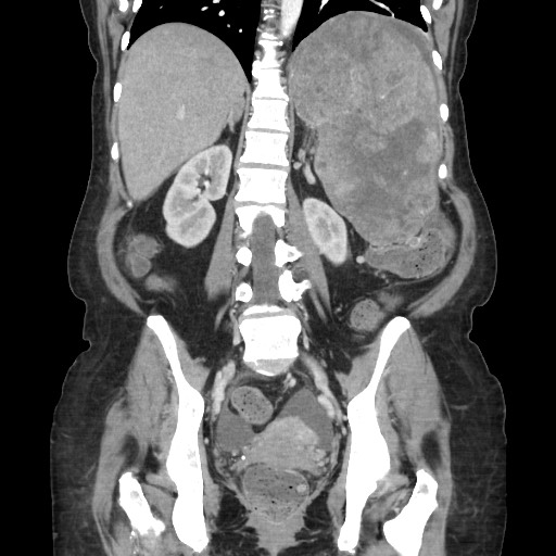 File:Acinar cell carcinoma of the pancreas (Radiopaedia 75442-86669 Coronal C+ portal venous phase 84).jpg