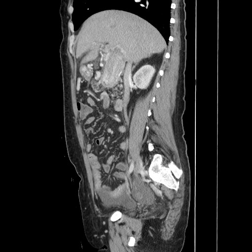 File:Acinar cell carcinoma of the pancreas (Radiopaedia 75442-86669 Sagittal C+ portal venous phase 78).jpg