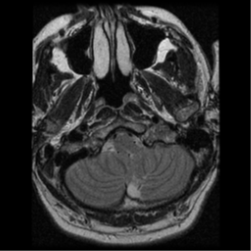 File:Acoustic schwannoma (Radiopaedia 39170-41387 Axial T2 3).png
