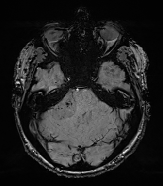 Acoustic schwannoma (Radiopaedia 50846-56358 Axial SWI 27).png