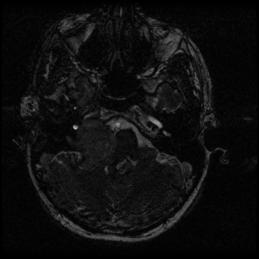Acoustic schwannoma - eroding petrous apex (Radiopaedia 39674-42004 Axial T2 22).png