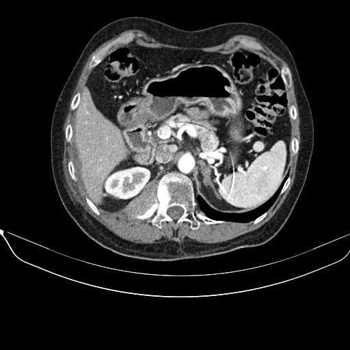 File:Acquired adrenal hyperplasia - due to thymic carcinoid tumor (Radiopaedia 21269-21184 C+ arterial phase 32).jpg