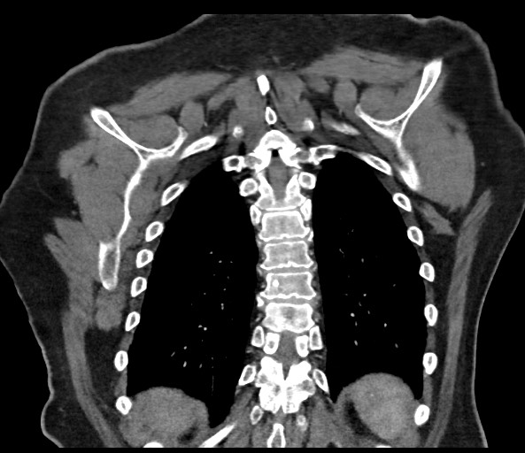 Acromioclavicular joint cyst (Radiopaedia 58455-65610 Coronal C+ arterial phase 115).jpg