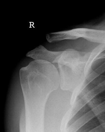 File:Acromioclavicular joint injury (type II) (Radiopaedia 35958).jpg