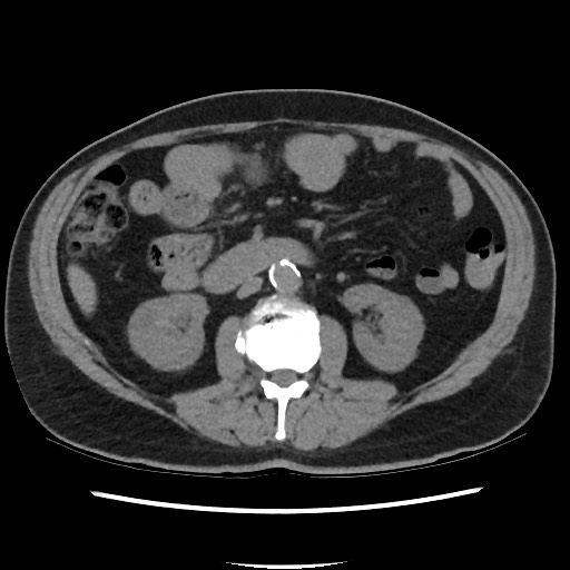 Active colonic bleed on CT (Radiopaedia 49765-55025 Axial non-contrast 36).jpg