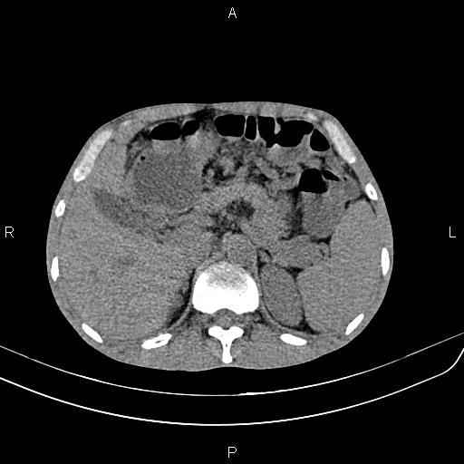 File:Active crohn disease (Radiopaedia 87133-103397 Axial non-contrast 27).jpg
