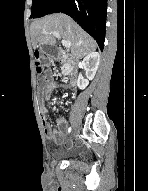 Active crohn disease (Radiopaedia 87133-103397 Sagittal C+ arterial phase 31).jpg