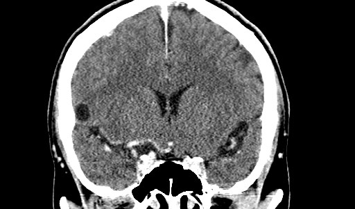 File:Active neurocysticercosis before and after therapy (Radiopaedia 71710-82099 Coronal C+ delayed 33).jpg