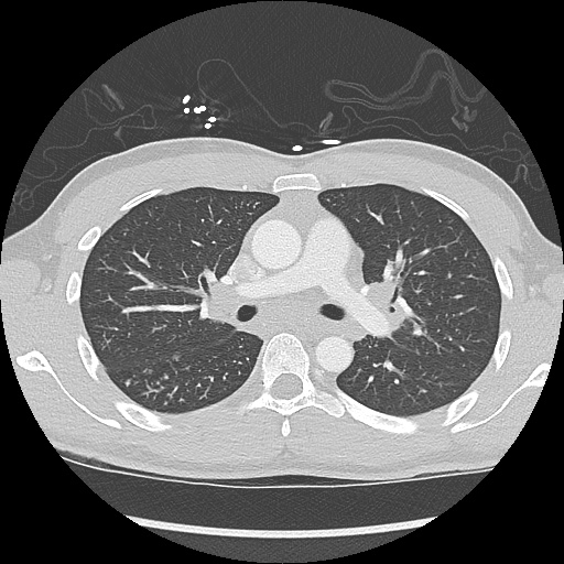 File:Active right ventricular cardiac sarcoidosis (Radiopaedia 55596-62101 Axial lung window 17).jpg