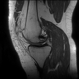 Acute-on-chronic transient lateral patellar dislocation with trochlear dysplasia (Radiopaedia 84099-99349 Sagittal PD 66).jpg